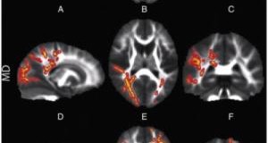 These brain images, taken with DTI, show water diffusion within the white matter of children with sensory processing disorders. Row FA: The blue areas show white matter where water diffusion was less directional than in typical children, ndicating impaired white matter microstructure. Row MD: The red areas show white matter where the overall rate of water diffusion was higher than in typical children, also indicating abnormal white matter. Row RD: The red areas show white matter where SPD children have higher rates of water diffusion perpendicular to the axonal fibers, indicating a loss of integrity of the fiber bundles comprising the white matter tracts. (Credit: Image courtesy of University of California - San Francisco)