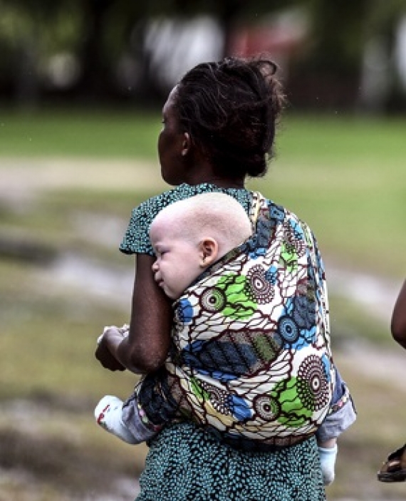 United Nations To Tanzanian Politicians, Stop The Use Of Albinos For Witchcraft